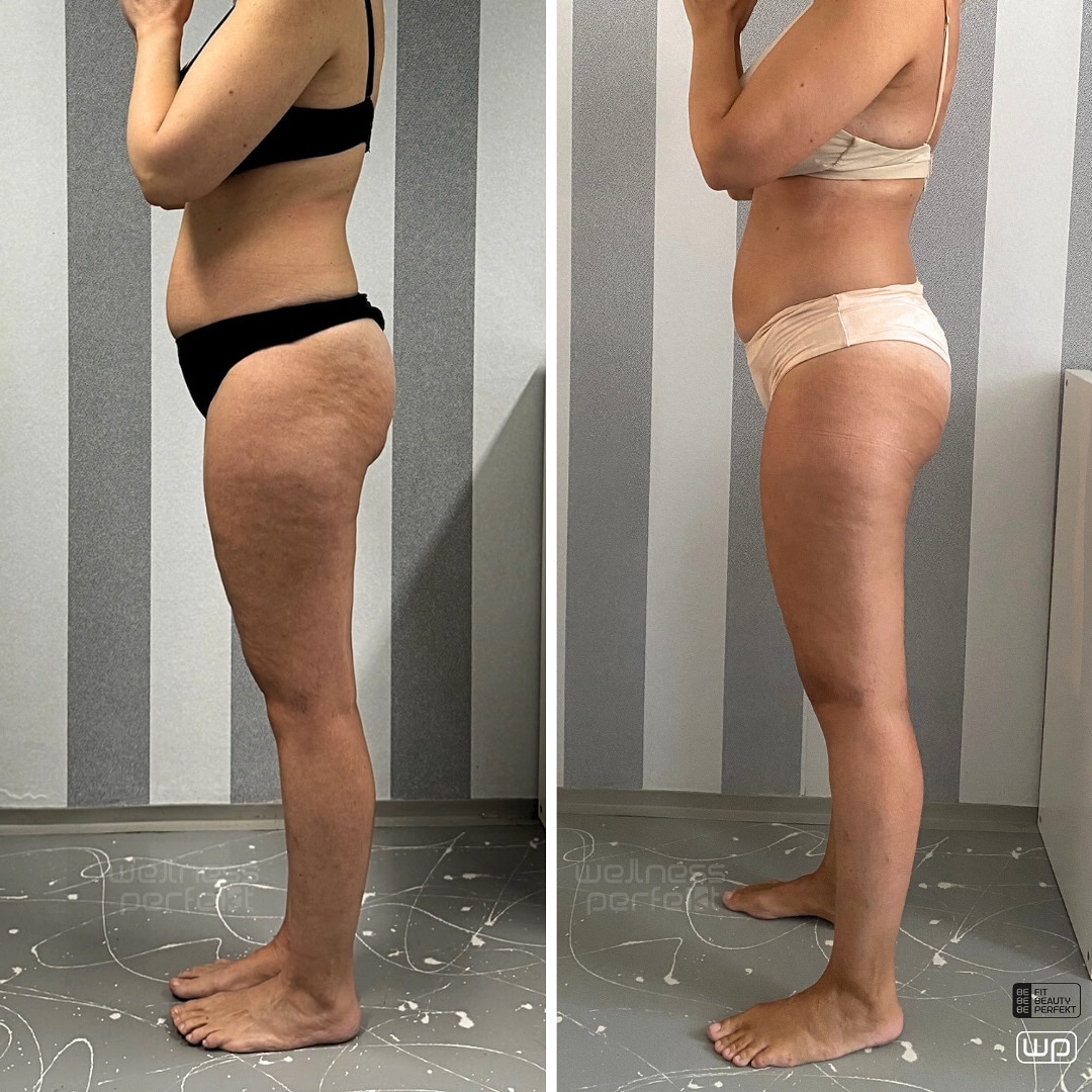 Arosha kehamähised tulemused - enne ja pärast 3