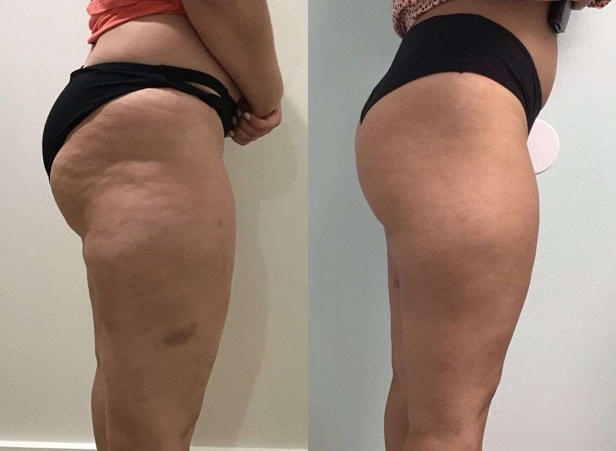 Vela Shape tulemused - enne ja pärast 5