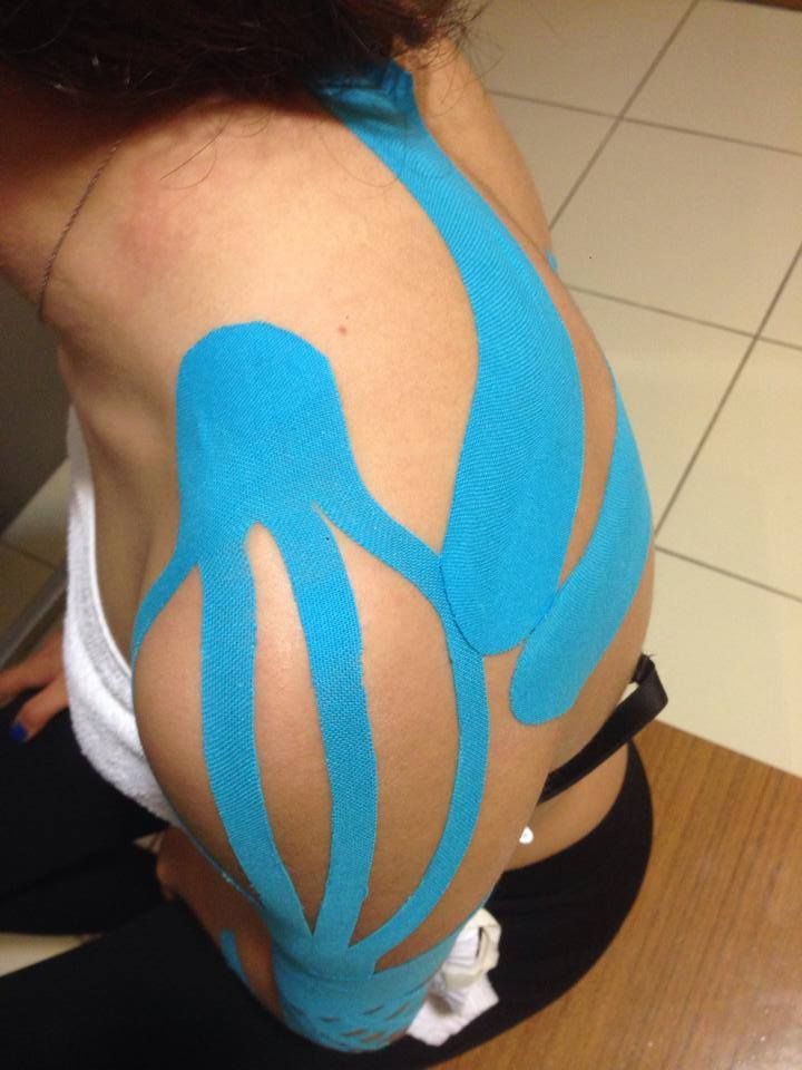 Kinesio teipimine näide 4